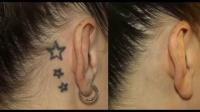 Best Laser Tattoo Removal in Melbourne image 1